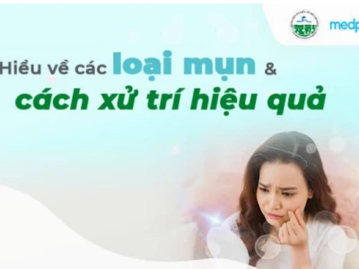 Phân biệt rõ 9 loại mụn thường gặp và cách điều trị hiệu quả