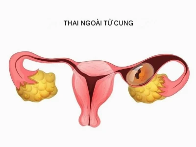 Phân biệt rõ máu báo thai và máu kinh: Dấu hiệu nào cần lưu tâm?