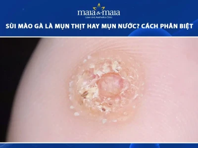 Phân biệt Sùi mào gà và Mụn thịt: Nhận biết sớm, phòng tránh hiệu quả