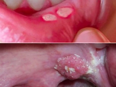 Phân biệt sùi mào gà và nhiệt miệng: Dấu hiệu, nguyên nhân và cách xử lý