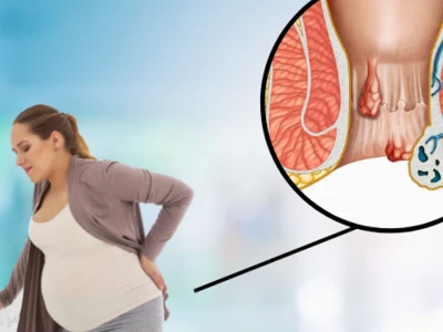 Phân biệt trĩ nội và trĩ ngoại: Dấu hiệu nhận biết và cách điều trị