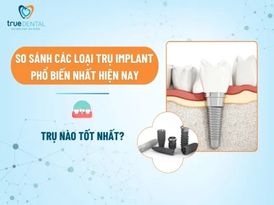 So sánh các loại trụ implant: Lựa chọn nào tốt nhất cho bạn?